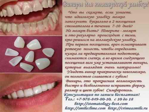 Виниры для голливудской улыбки, Симферополь. Виниры для голливудской улыбки, Симферополь.